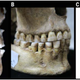 Adult skulls showing edge-to-edge bite (A and B), and an adult skull showing a slight overbite (C).